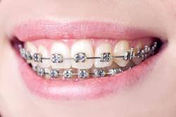 Dental Braces (Metallic) Full Mouth